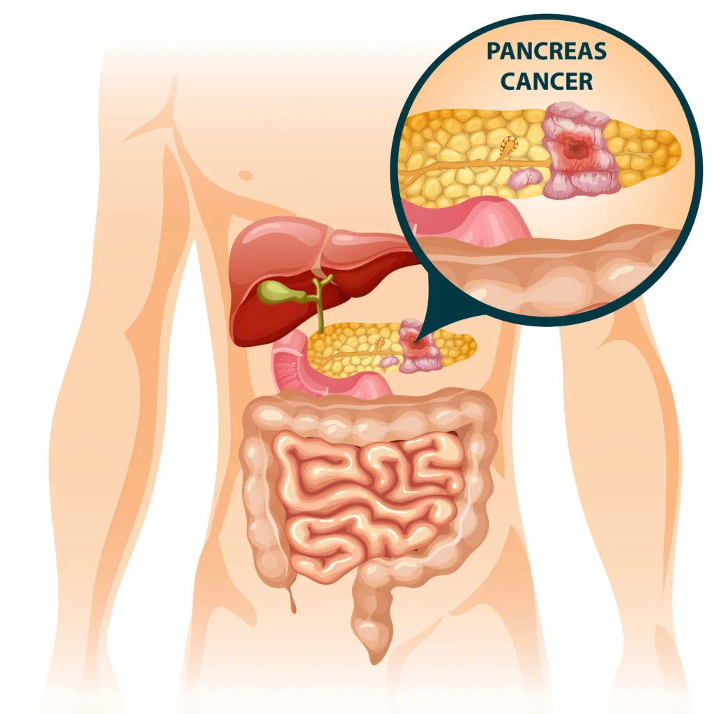 Pancreatic Cancer
Scientific research for the cure of pancreatic cancer with lab equipment and cancer cells under study