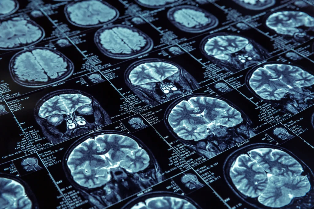 Microscopic view of glioblastoma brain tumor cells with a representation of medical research breakthroughs offering new hope in brain cancer treatment.
